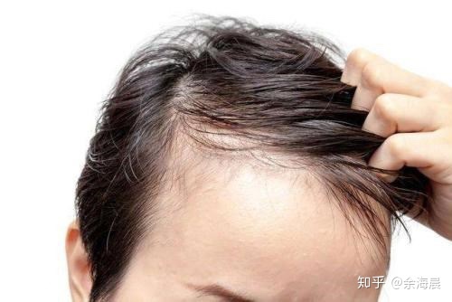  🤔头发天天掉，竟和烫发、染发没关系！