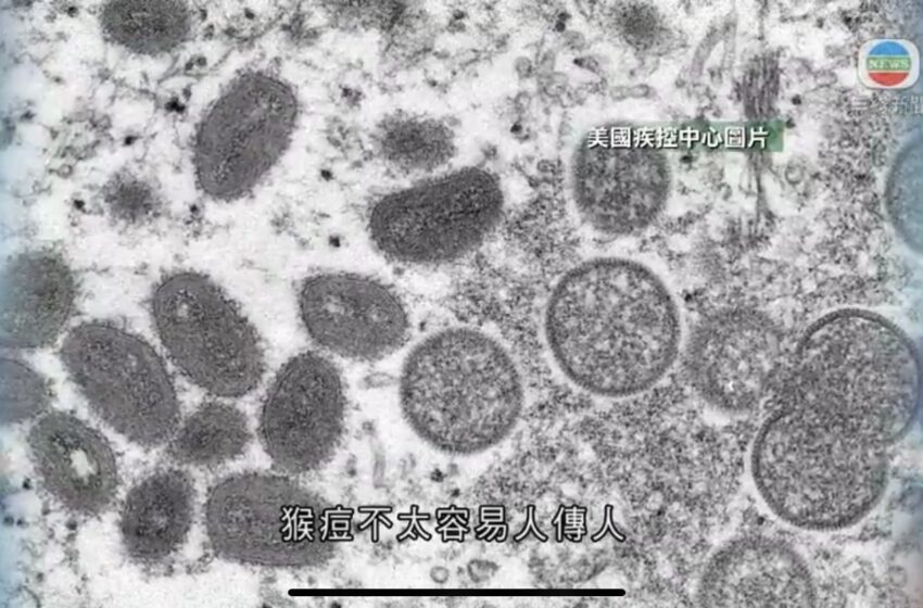  🔵澳洲加拿大均首现猴痘病例专家认为未必于人群中广泛传播