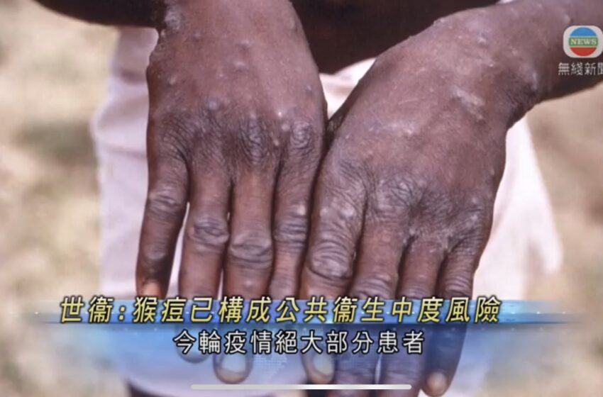  🔵全球录逾377宗猴痘确诊及疑似个案 世衞称对公共衞生构成中度风险